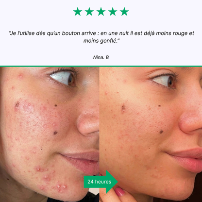 SOS Boutons — Soin Anti-Acné Ciblé | Résultats en 24h