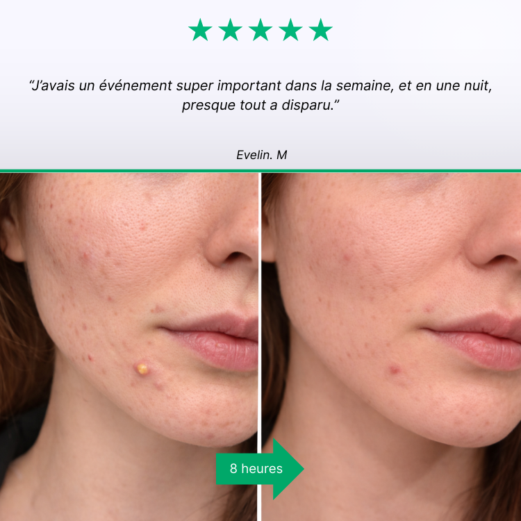 SOS Boutons — Soin Anti-Acné Ciblé | Résultats en 24h